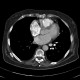 Pulmonary hypertension, obliteration of the right pulmonary artery, hypertrophy of bronchial artery, mosaic perfusion: CT - Computed tomography